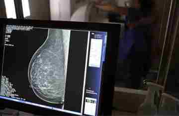  AGU processa médico que apontou mamografia como causadora de câncer 